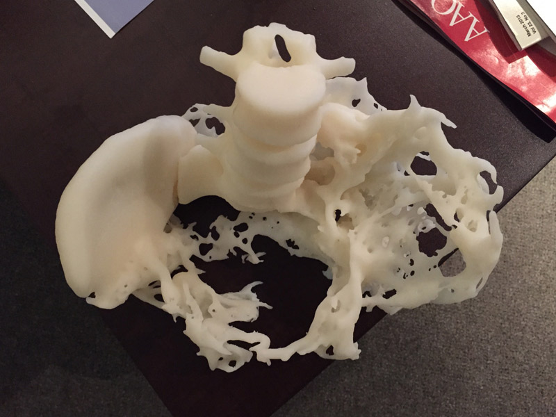 pelvic bone with heterotopic ossification 