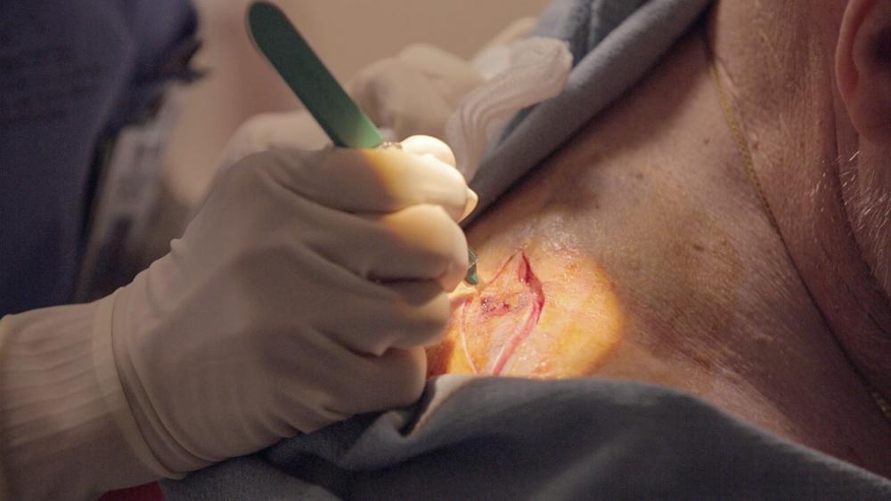 Close up of Josephine drawing an outline around the melanoma on patient's shoulder 